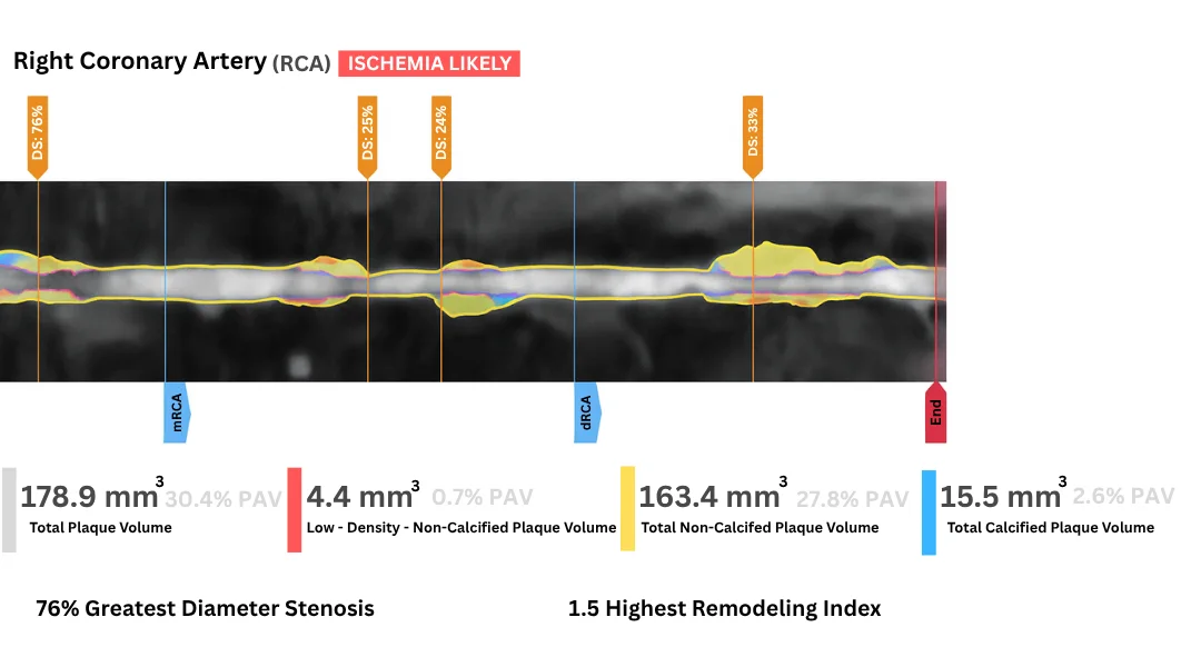 Coronary artery reconstructed in 3D from a CCTA scan